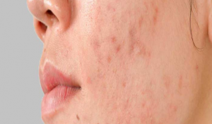 Effective Acne Scar Treatments: Insights from a Skin Specialist